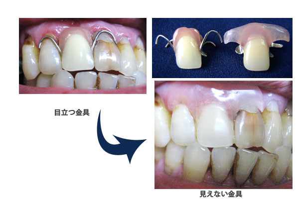 目立つ金具と見えない金具