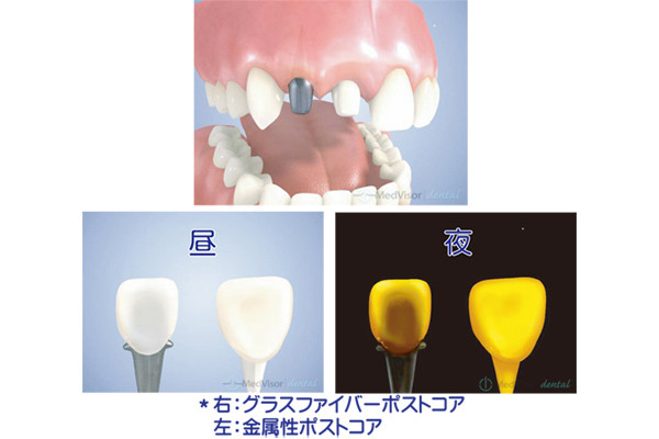 ファイバーポスト２