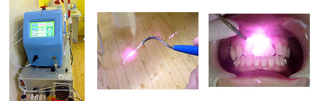 レーザー１・レーザー２・レーザー麻酔