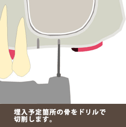 ソケットリフト２