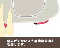 ソケットリフト１