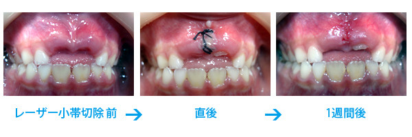 一般外科手術にレーザー