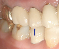 メタルセラミッククラウン