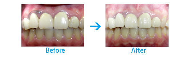 歯肉色素沈着除去にレーザー