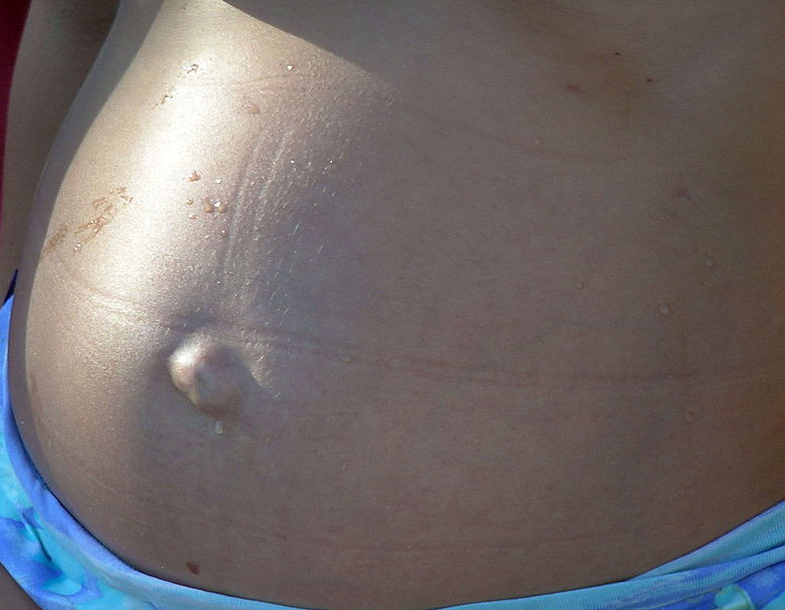 Umbilical Hernia