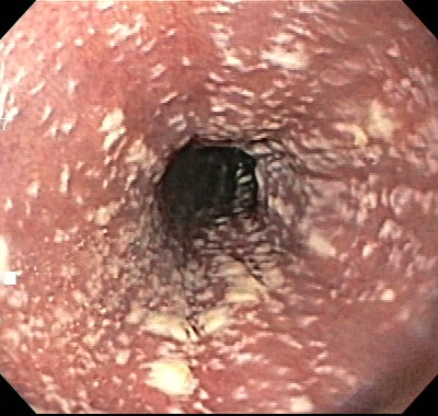Multiple whitish Candida lesions in the esophagus