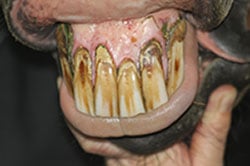 Zahnstein, Zahnfleischentzündung