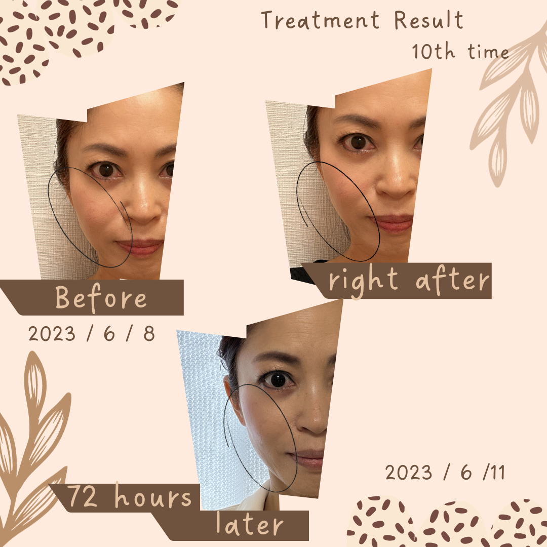 6月7月美容鍼経過報告