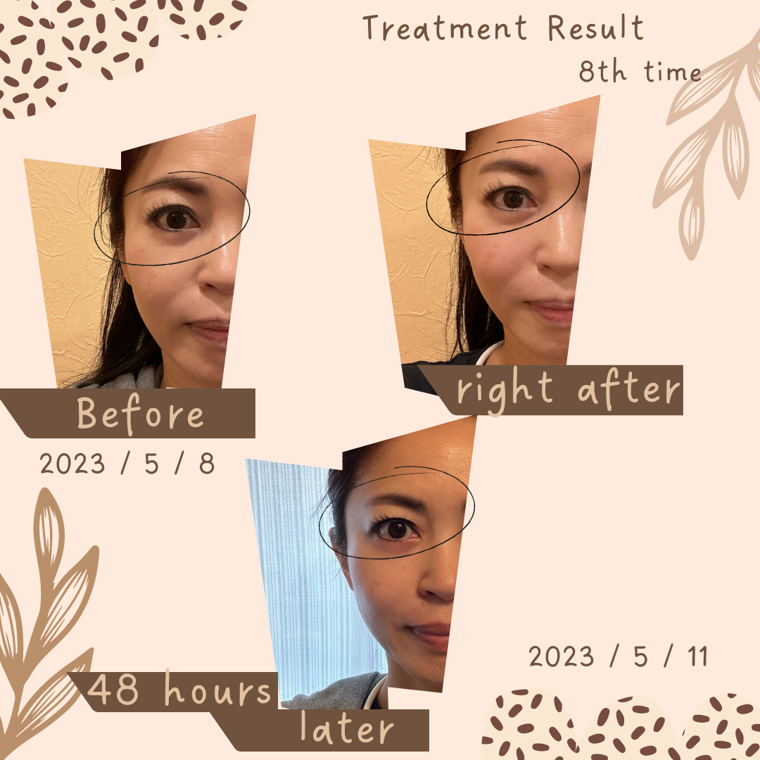 5月の美容鍼経過報告！