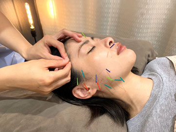 お顔の美容鍼30分の様子 深くリラックス