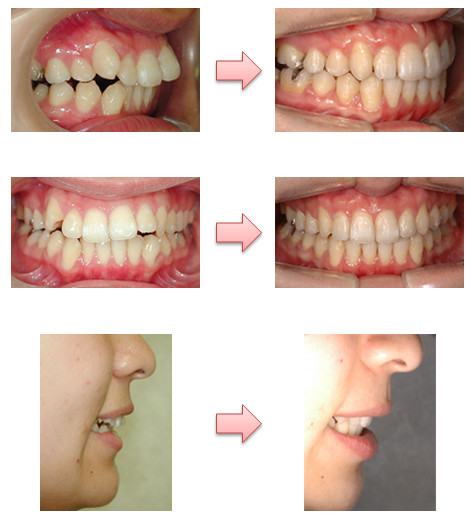 治療期間：約２年