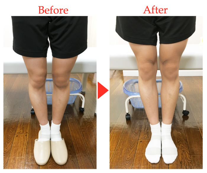 膝痛の施術前・施術後の写真