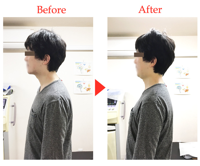 肩こりの施術前・施術後の写真