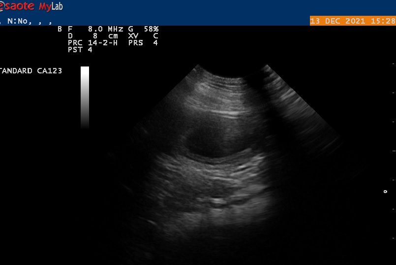 Echo Saartje. Middenin (donkere vlek) vruchtzakje met daarin foetus. Hieronder een video van de echo. De zwarte vlekjes zijn vruchtzakjes.