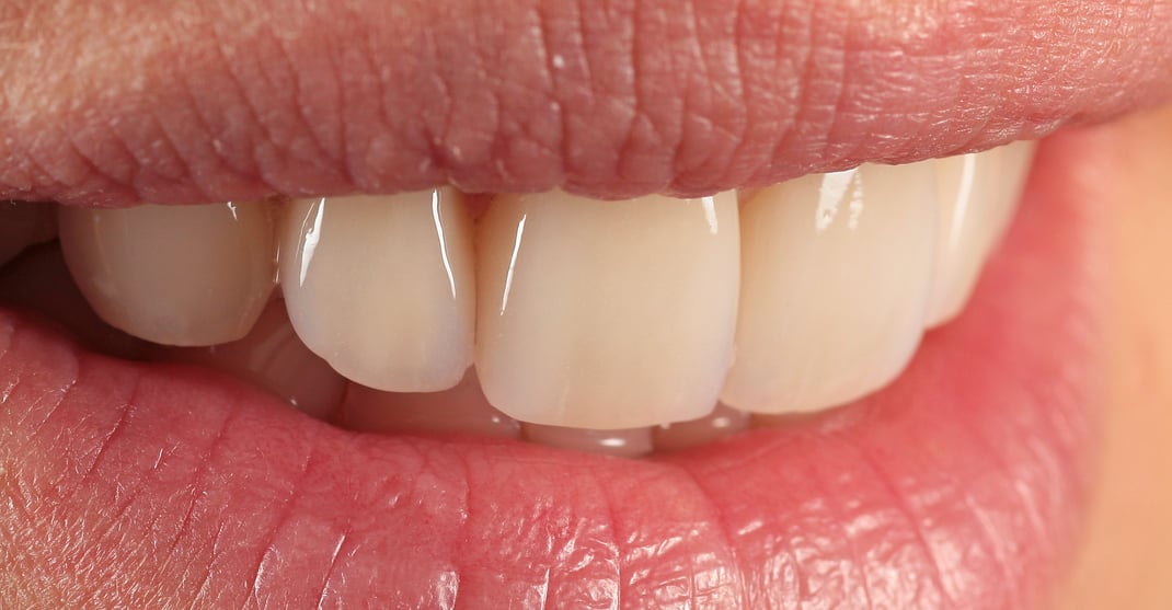 Ästhetischer Zahnersatz, Veneers auf vier Schneidezähnen. www.mb-dental.de