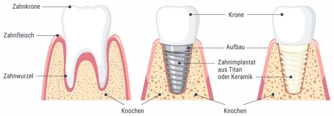 Zahnimplant, Titanimplantat, Keramikimplantat - Tagesklinik für Kieferchirurgie und Gesichtschirurgie in Schorndorf - has-shadow