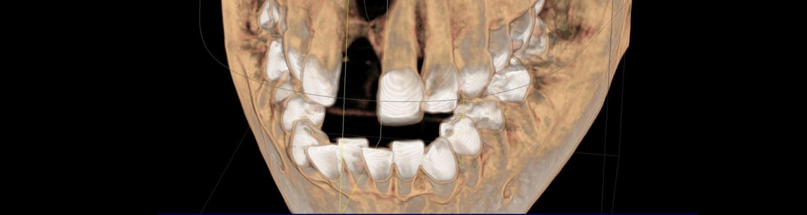 Knochenaufbau, Augmentation, Implantologie in Schorndorf - has-shadow
