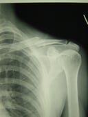 鎖骨骨折　　保存療法　鎖骨骨折　国分寺こみね鍼灸整骨院