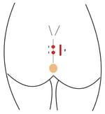 pit picking for pilonidal sinus