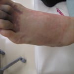 第五中足骨骨折　保存療法　国分寺こみね鍼灸整骨院