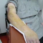 前腕骨遠位端骨折　　保存療法　国分寺こみね鍼灸整骨院