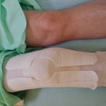 プラトー骨折　保存療法　国分寺こみね鍼灸整骨院