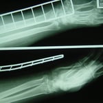 前腕骨遠位端骨折　　保存療法　国分寺こみね鍼灸整骨院