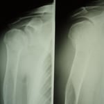 脱臼骨折　脱臼整復後骨折の固定処置　保存療法　国分寺こみね鍼灸整骨院