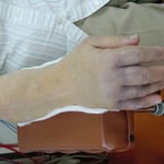 前腕骨遠位端骨折　　保存療法　国分寺こみね鍼灸整骨院