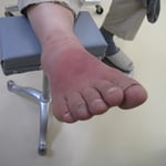 痛風　国分寺こみね鍼灸整骨院