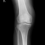 プラトー骨折　保存療法　国分寺こみね鍼灸整骨院