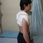 鎖骨骨折　保存療法　一か月半でバスケットボール復帰　国分寺こみね鍼灸整骨院