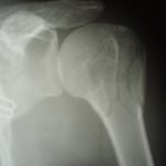 上腕骨骨頭骨折　保存療法　国分寺こみね鍼灸整骨院