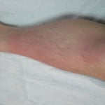 蜂窩織炎　国分寺こみね鍼灸整骨院