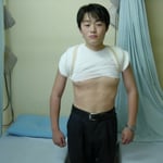 鎖骨骨折　保存療法　一か月半でバスケットボール復帰　国分寺こみね鍼灸整骨院