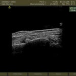 前腕骨遠位端骨折　超音波観察装置　保存療法　国分寺こみね鍼灸整骨院