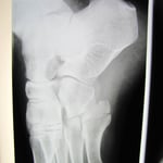 第五中足骨骨折　保存療法　国分寺こみね鍼灸整骨院