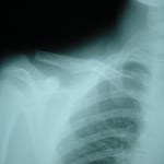 鎖骨骨折　保存療法　一か月半でバスケットボール復帰　国分寺こみね鍼灸整骨院