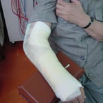 前腕骨遠位端骨折　　保存療法　国分寺こみね鍼灸整骨院