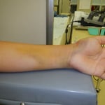 前腕骨不全骨折　保存療法　国分寺こみね鍼灸整骨院