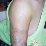 脱臼骨折　脱臼整復後骨折の固定処置　保存療法　国分寺こみね鍼灸整骨院