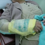 前腕骨遠位端骨折　　アイシング　保存療法　国分寺こみね鍼灸整骨院