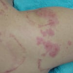 帯状疱疹　国分寺こみね鍼灸整骨院