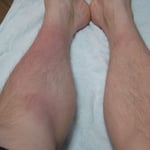 蜂窩織炎　国分寺こみね鍼灸整骨院