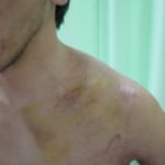 左鎖骨骨折　保存療法　国分寺こみね鍼灸整骨院