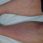 蜂窩織炎　国分寺こみね鍼灸整骨院