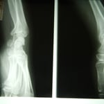 前腕骨不全骨折　保存療法　国分寺こみね鍼灸整骨院