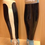 Carbon-Schienbeindruckschutz nach Wadenbeinfraktur