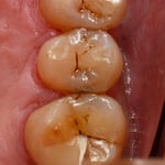 術後１ｹ月くらい。これから補綴予定。