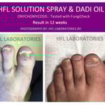 Schimmelnagelbehandeling